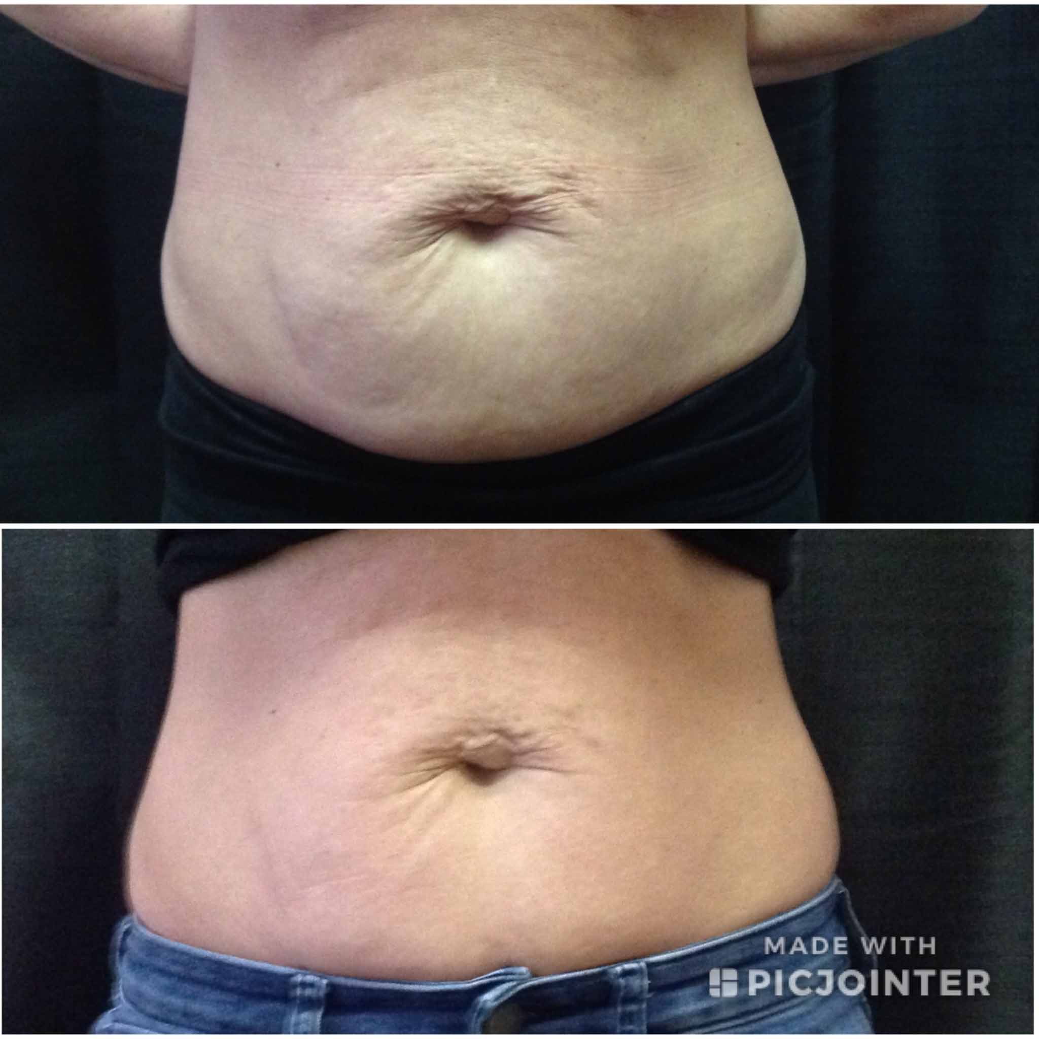 Flank Fat Removal with Velashape  Non-surgical Body Contouring Las Vegas NV